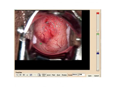 Colposcopy software for video colposcope and with digital cameras