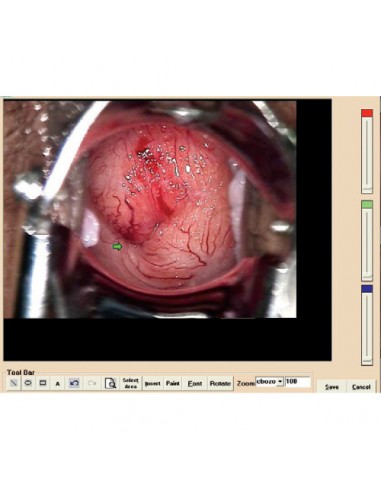 Colposcopy software for video colposcope and with digital cameras