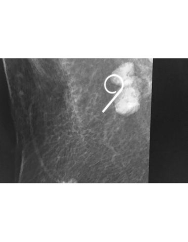 Repositionable breast Localization wire 20G x 5cm / box of 10